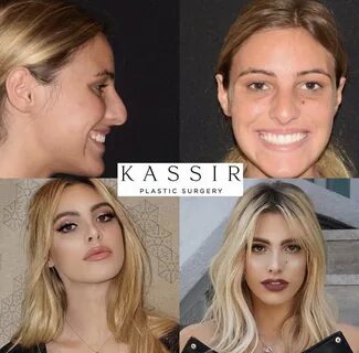 Lele pons before and after surgery