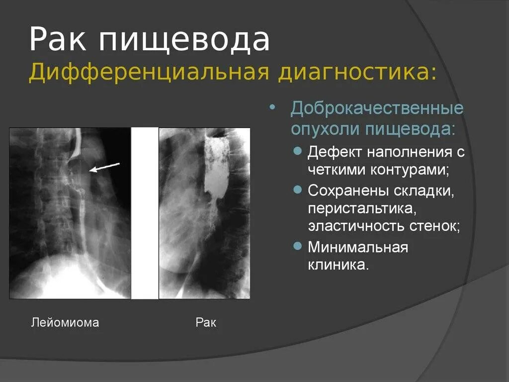 Новообразование пищевода. Злокачественные опухоли пищевода. Опухоль пищевода диагностика. Рентгенодиагностика опухоли пищевода.