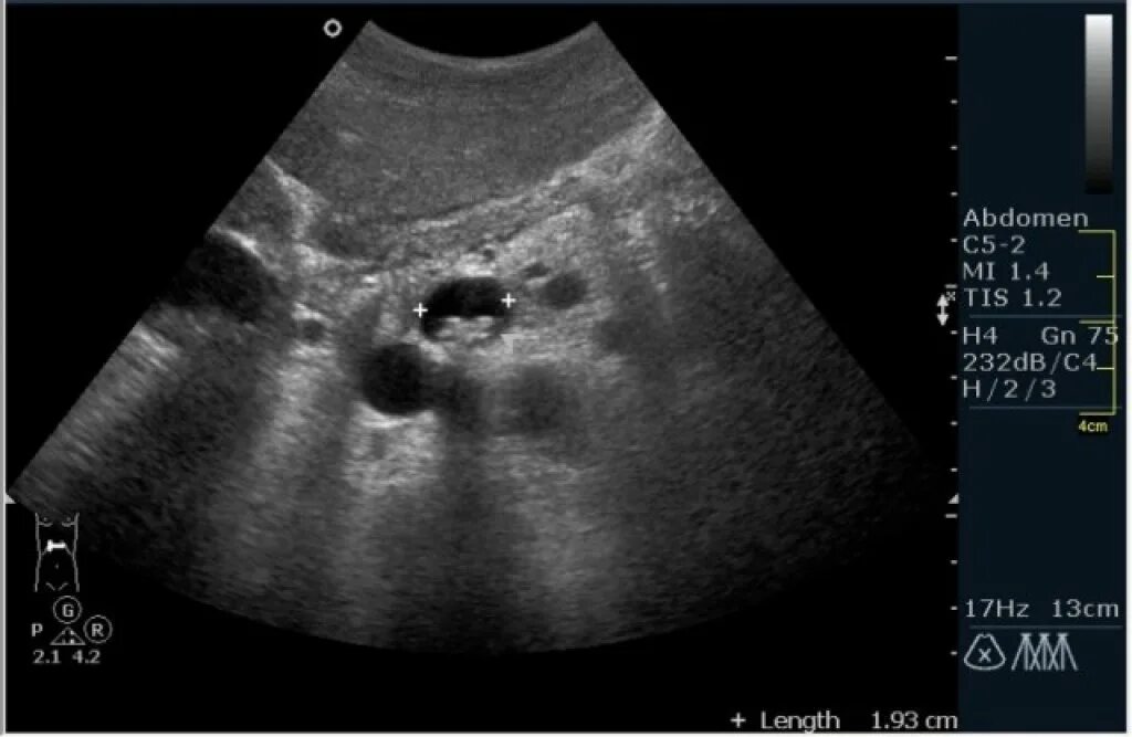 Узи жкб. УЗИ желчного пузыря ЖКБ. Желчекаменная болезнь УЗИ. Холестериновые камни в желчном на УЗИ.