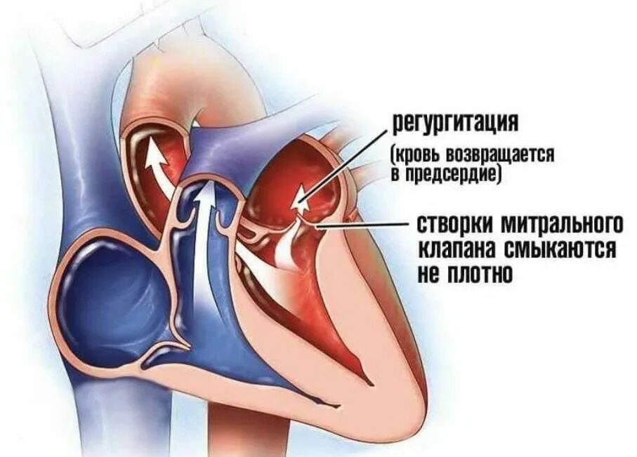 Сердечная недостаточность митрального клапана. Недостаточность створок митрального клапана. Ревматическая митральная недостаточность. Недостаточность двустворчатого (митрального) клапана. Недостаточность митрального клапана регургитация.