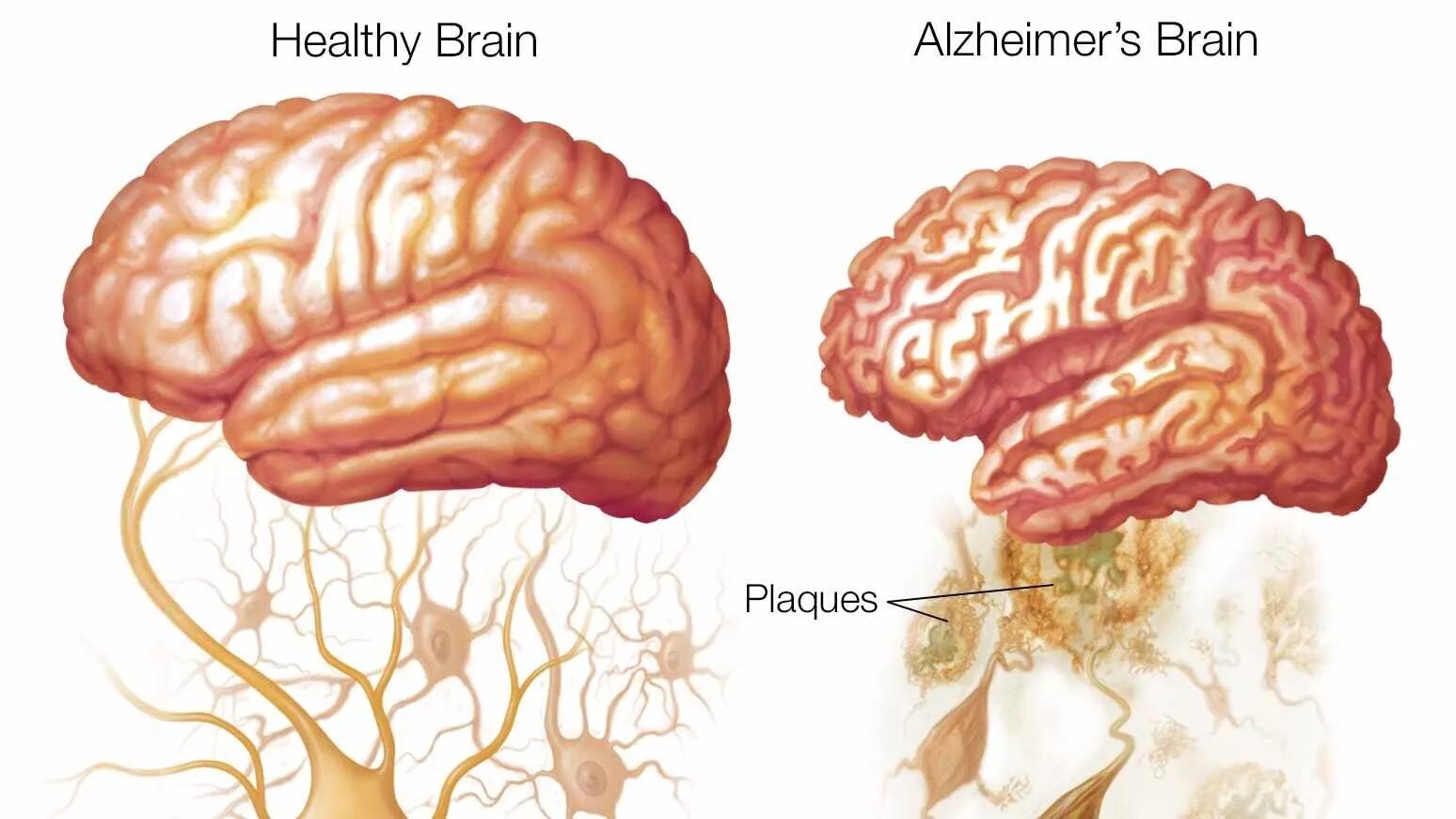 Мозг слабоумие. Болезнь Альцгеймера.