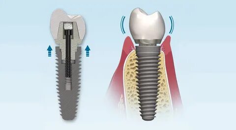 Дентальные имплантаты, интегрированные в структуру костной ткани или слизис...