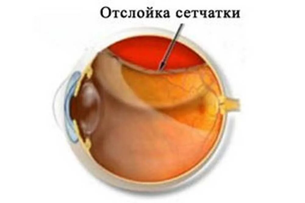 Тракционная отслойка сетчатки. Регматогенная отслойка сетчатки. Тотальная воронкообразная отслойка сетчатки. Отслоение сетчатки симптомы.