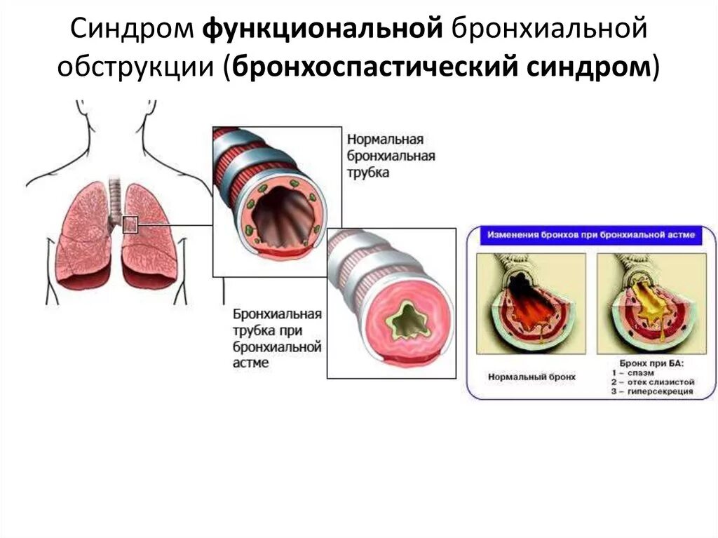 Бронхиальная болезнь легких. Клинические признаки бронхиальной обструкции. Синдром бронхиальной обструкции при бронхиальной астме. Обструкция дыхательных путей при бронхиальной астме. Синдром бронхиальной обструкции симптомы.