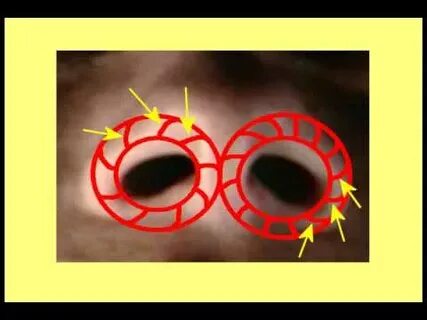 Body hole