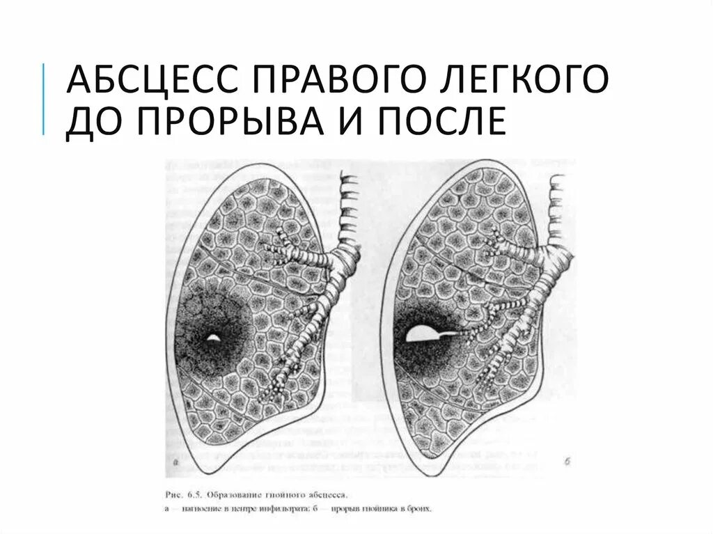 После абсцесса легкого. Абсцесс легкого 2 стадия. Стадии абсцесса легкого. Прорыв абсцесса легких.