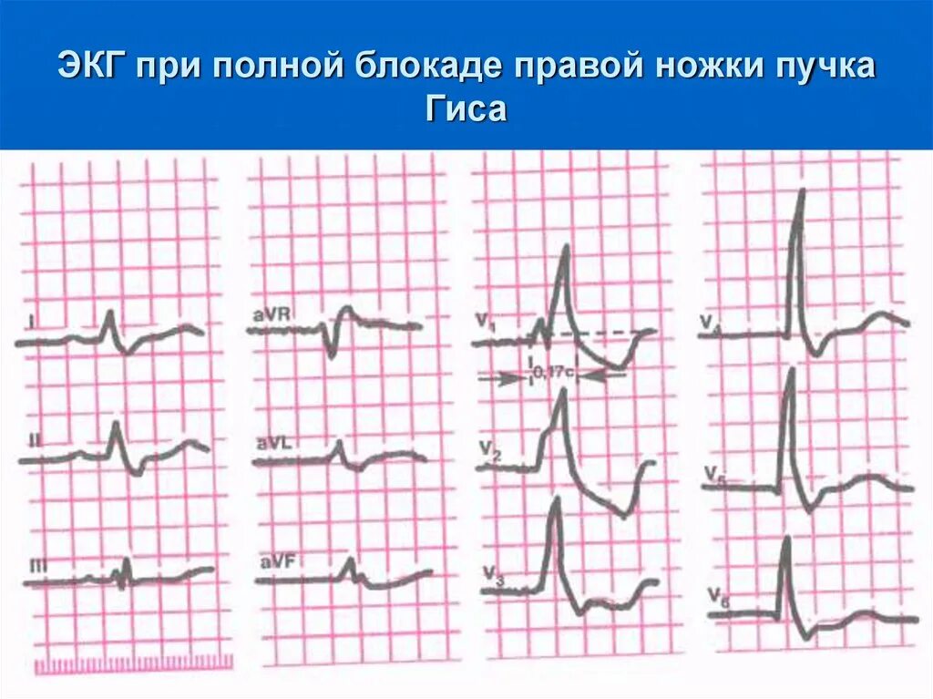 Гиса блокада пнпг. Полная блокада левой ножки пучка Гиса на ЭКГ. ЭКГ при блокаде левой ножки пучка Гиса. Блокада правой ножки пучка Гиса на ЭКГ. Блокада левой ножки пучка Гиса на ЭКГ.