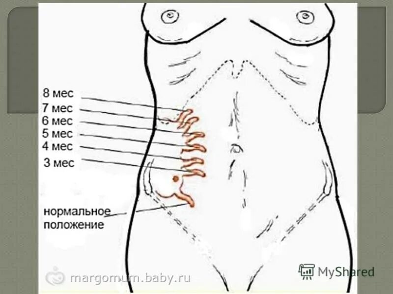 Расположение аппендикса при беременности. Расположение аппендицита у человека схема. Аппендицит у беременных расположение. Расположение аппендицита у женщин схема.