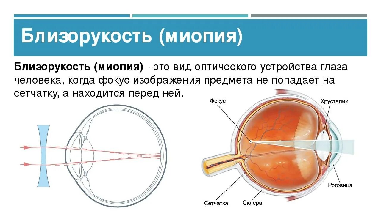 Заболевание органов зрения миопия. Строение глаза при миопии. Строение близорукого глаза. Изменение глазного яблока при близорукости. Миша страдает близорукостью а его брат дальнозоркостью