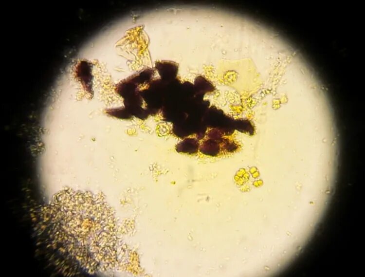 Кальтопроктеин в кале. Микроскопия кала крахмал. Копрограмма микроскопия. Внеклеточный крахмал в микроскопии кала. Зерна крахмала в Кале микроскопия.