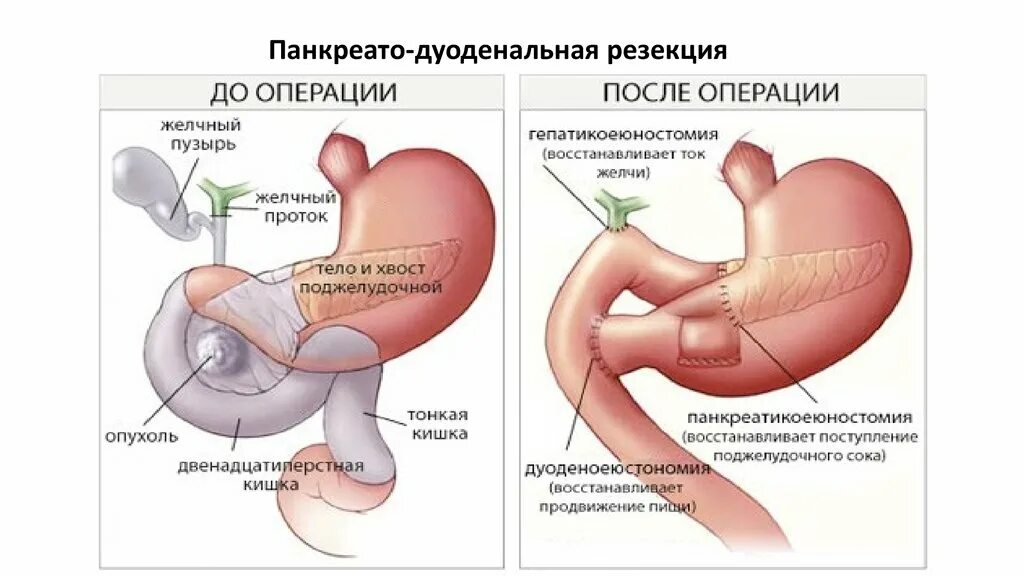 Операция Уиппла на поджелудочной железы. Операция Уиппла (панкреатодуоденальная резекция). Панкреатодуоденальная резекция ход операции.