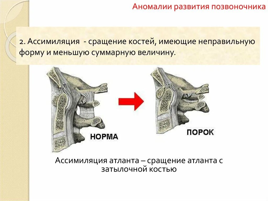 Аномалии развития позвоночника. Аномалии развития с2 позвонка. Пороки развития позвоночника. Аномалия развития позвонка. Ассимиляция Атланта затылочной.