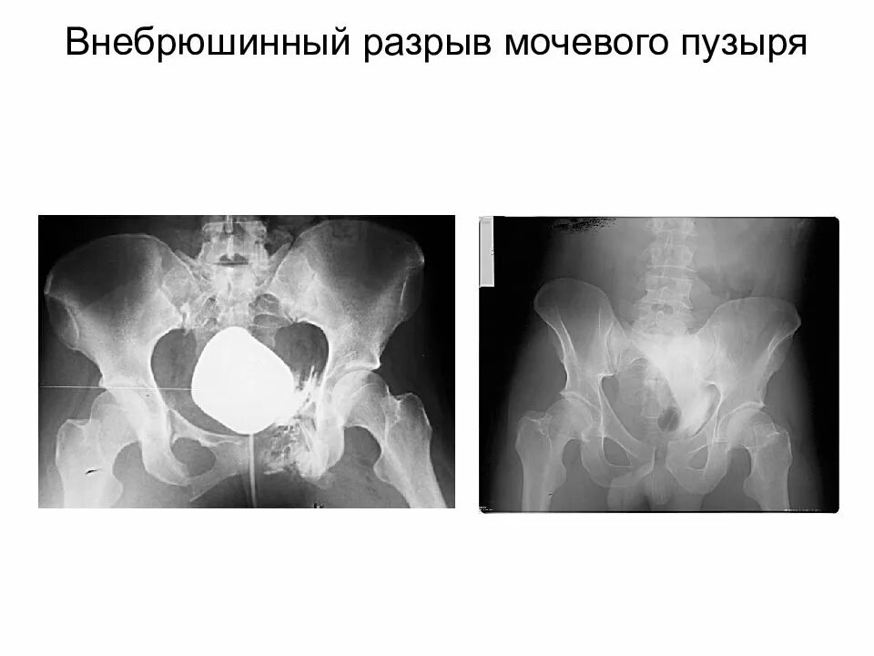 Травма мочевого пузыря цистография. Цистография разрыв мочевого пузыря. Цистография мочевого пузыря рентген. Внутрибрюшинный разрыв мочевого пузыря рентген.