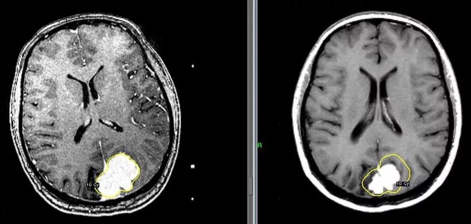 Менингиома головного мозга мрт. Менингиомы головного мозга на кт. После операции менингиомы головного мозга