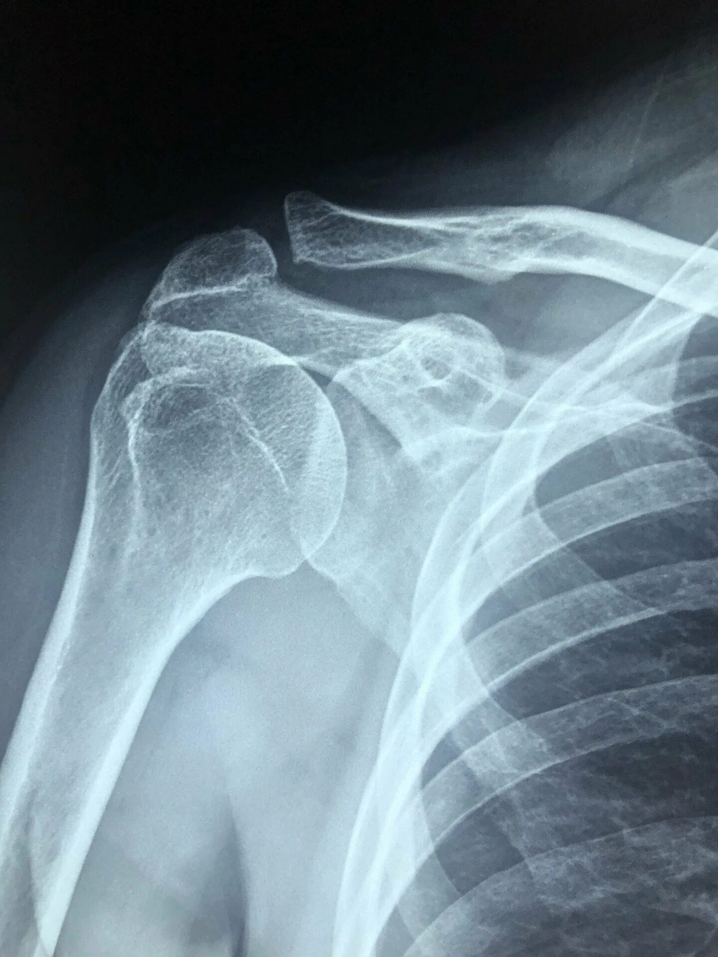 Рентген плеча норма. Рентген здоровой плечевой кости. Рентгенограмма плечевого сустава. Рентген здорового плечевого сустава.