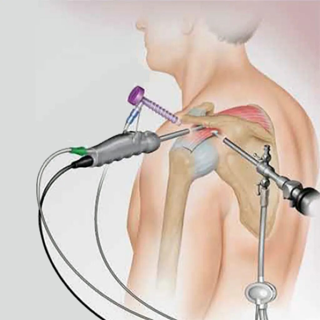 Артроскопическая субакромиальная декомпрессия плечевого сустава. Артроскопические операции плечевого сустава Москва. Операция акс артроскопия. Операция на плече артроскопия. После операции болят плечи