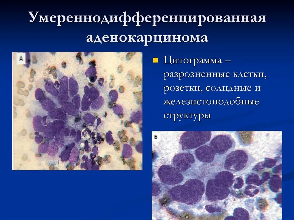 Цитограмма аденокарциномы. Вульварная плоскоклеточная аденокарцинома. Умеренно дифференцированная аденокарцинома. Умеренно дифференцированные опухоли. Умеренно дифференцированный плоскоклеточный рак