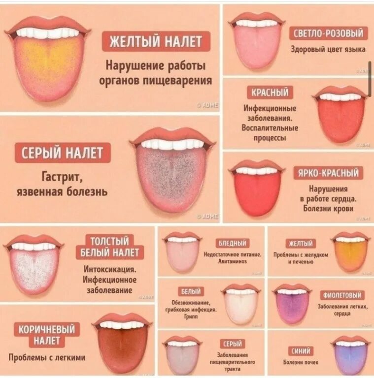 Варианты определения языка. Заболевания по цвету языка. язык здорового и больного человека.