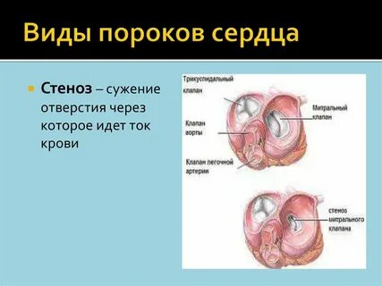 Пороки металла