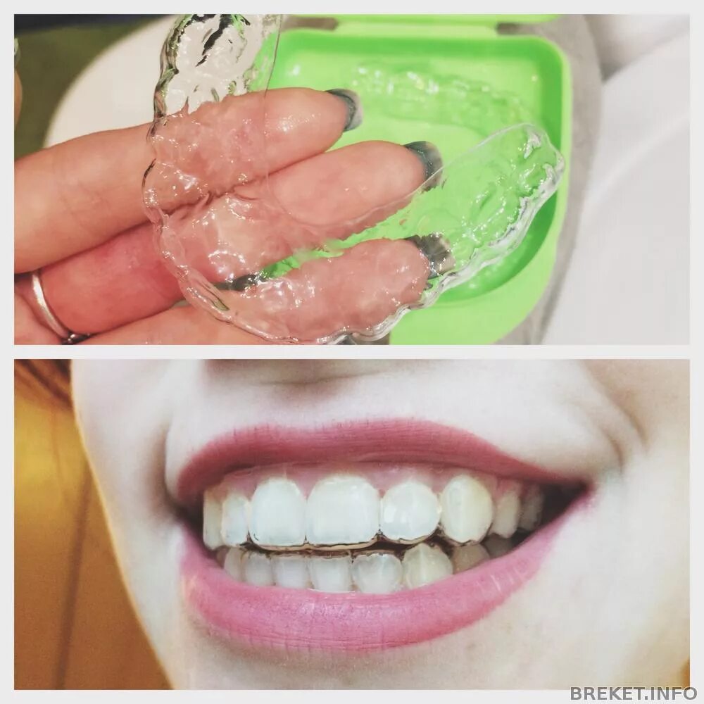 Можно ли кап. Капа для зубов стоматологическая. Размер кап для зубов. Капа двухчелюстная для исправления прикуса. Эластопозиционер "корректор" каппа.