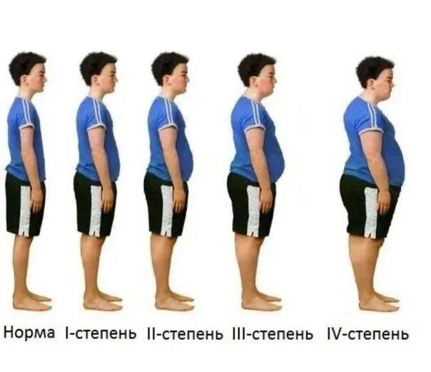 Ожирение 11 лет. Ожирение 1 степени у детей. Ожирение у подростков 1 степени. Ожирение 1 степени у подростка. Ожирение 1 степени у детей 14 лет.