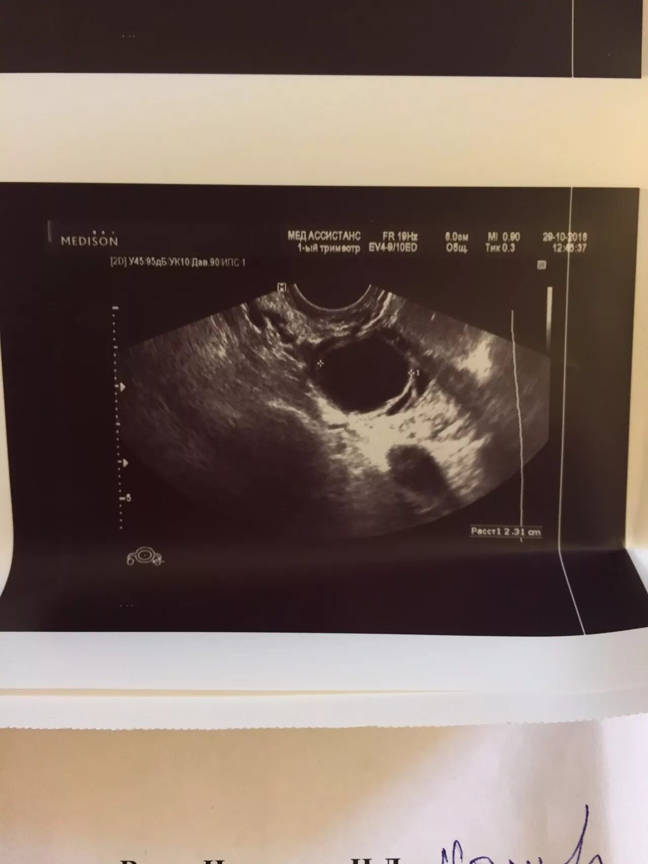 Узи на 24 день цикла. Узи на 3 день цикла. Узи на 18 день цикла. Узи на 18 день цикла. Фолликулогенез узи.