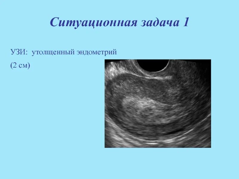 Эндометрий 11 мм