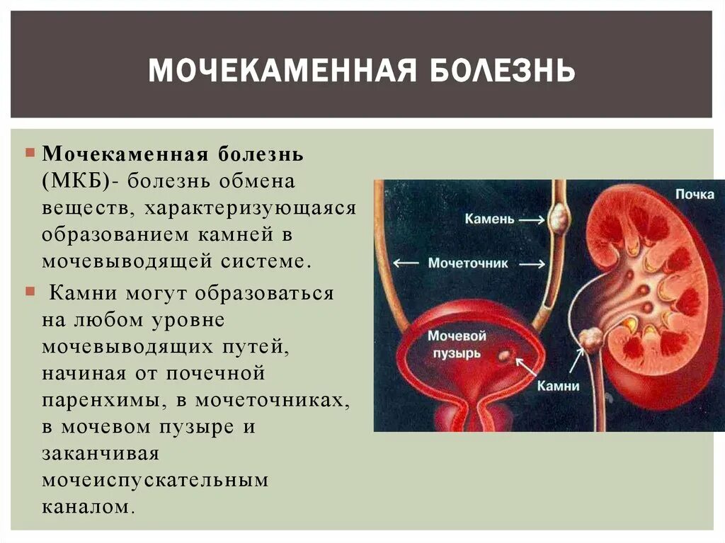 Почки научная статья. Заболевания мочевыделительной системы мочекаменная болезнь. Мочекаменная болезнь к 1 к2. Мочекаменная болезнь (уролитиаз). Мочекаменная болезнь урология камни мочеточника.