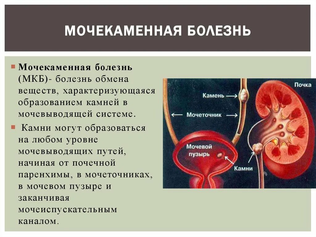 Причины заболевания почек 8 класс. Заболевания мочевыделительной системы мочекаменная болезнь. Мочекаменная болезнь (уролитиаз). Мочекаменная болезнь урология камни мочеточника. Система мочевыделения при мочекаменной болезни.