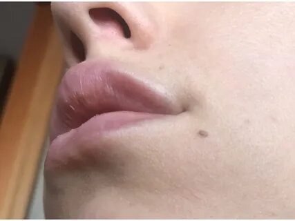 Почему верхняя губа