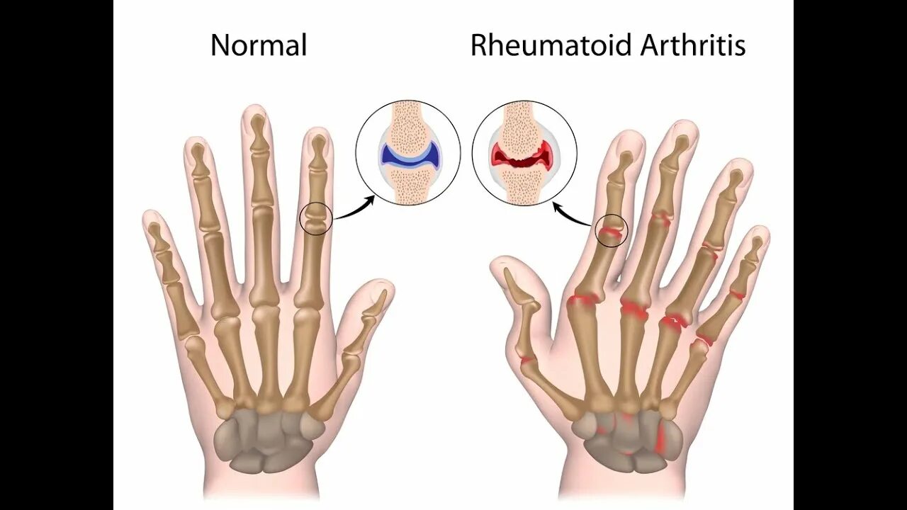 Суставы пальцев сильно. Паукообразная кисть ревматоидный артрит. Поражение суставов при ра.