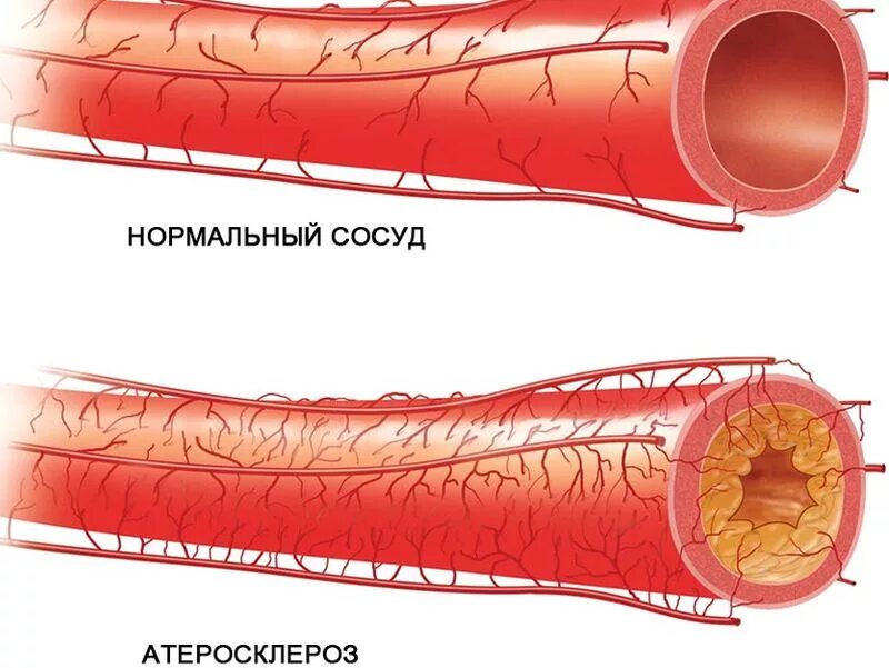 Отложение холестерина. Атеросклероз коронарных артерий симптомы. Атеросклероз венечных артерий сердца. Атеросклероз сосудов брахиоцефальных артерий. Нормальный сосуд и Атеросклерозный сосуд.