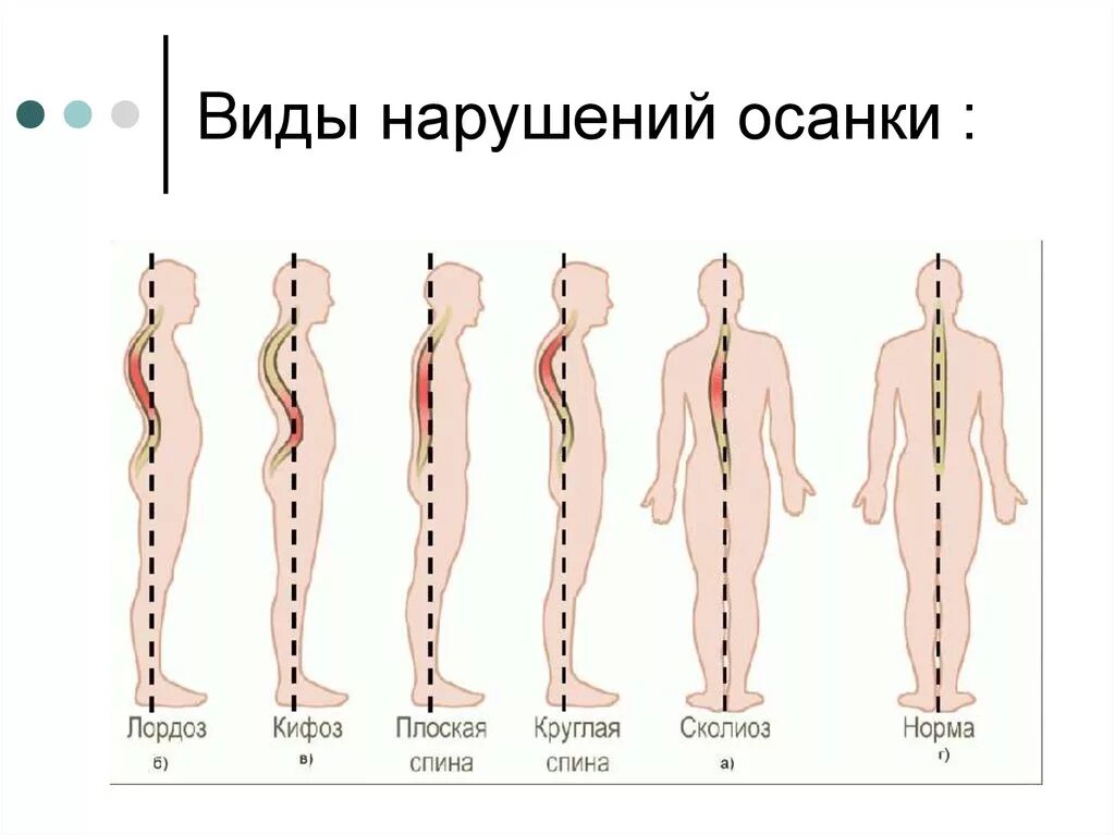 Нормальная поясница. Осанка и искривление позвоночника. Искривленный позвоночник. Типы осанки. Типы нарушения осанки.