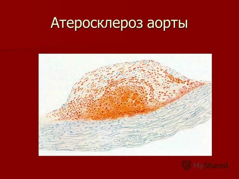 Атеросклероз брюшного. Атеросклеротическая бляшка аорты микропрепарат Судан 3. Атеросклероз аорты макропрепарат. Атеросклероз аорты микропрепарат. Атеросклероз аорты презентация.