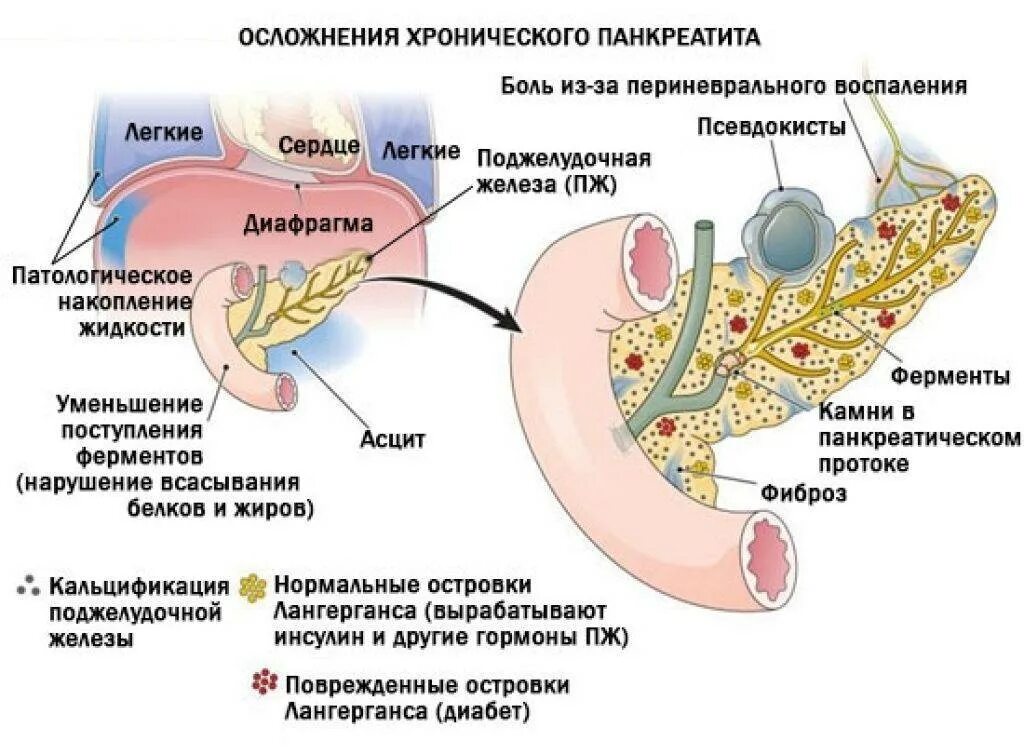 Схема терапии хронического панкреатита. Симптомы хронического панкреатита поджелудочной железы. Фазы заболевания хронического панкреатита. Поджелудочная железа при остром и хроническом панкреатите.