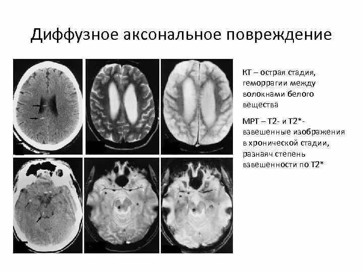 Диффузная травма головного. Диффузное аксональное повреждение мозга кт. Аксональное повреждение головного мозга на кт. Аксональное повреждение головного мозга мрт. Диффузное аксональное повреждение мрт.