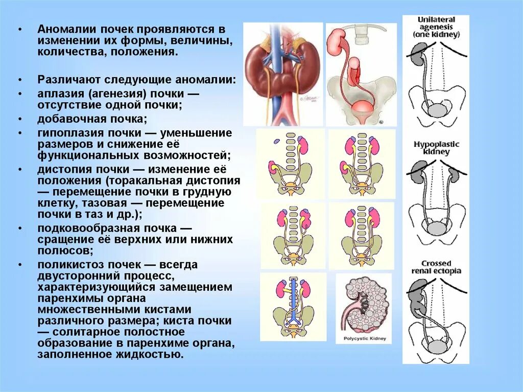 Аномалии расположения почек классификация. Аномалии развития почек. Аномалии развития почек структуры. Патология расположения почки.