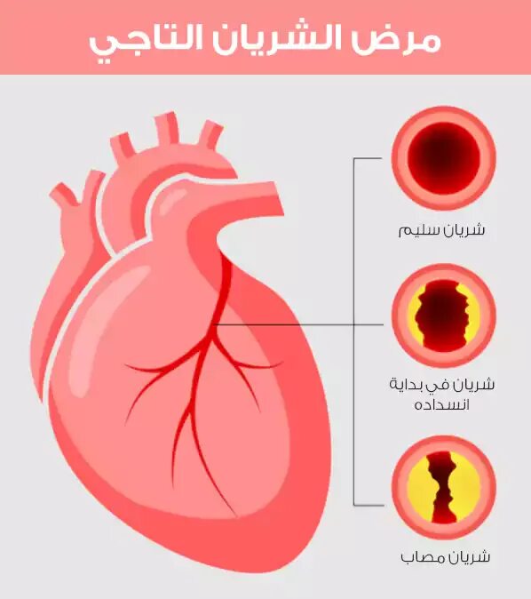 Ишемическая болезнь сердца снимок. Coronary heart disease. Coronary heart disease. Coronary heart disease. Coronary heart disease.