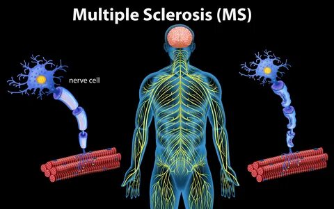 Human Anatomy of Multiple Sclerosis - Download Free Vectors, Clipart.