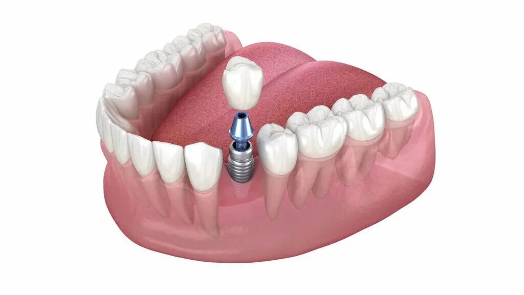 миниимпланты съемный протез.
