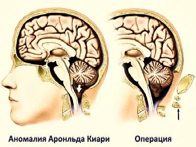 Что такое аномалия арнольда киари