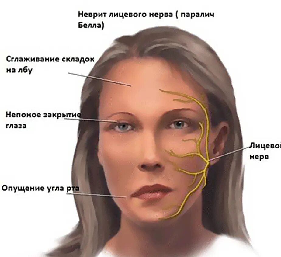 Неврит тройничного нерва симптомы. Паралич тройничного нерва симптомы.