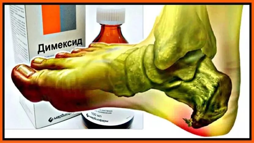 Компресс от пяточной шпоры. Димексид для пяточной шпоры. пяточная шпора компресс. димексид гель от пяточной шпоры. компресс с димексидом при пяточной шпоре.