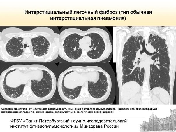 Интерстициальная пневмония на кт. Идиопатическая интерстициальная пневмония кт. Острая интерстициальная пневмония кт. Лимфоидная интерстициальная пневмония кт.