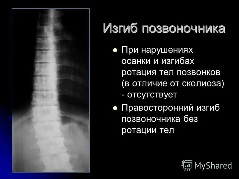 Нарушение изгиба позвоночника. Ротация тел позвонков. Заболевания позвоночника рентгенология. Ротация тел позвонков рентген. Степени ротации тел позвонков рентген.