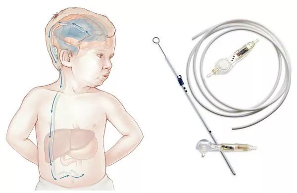 Гидроцефалия шунтирование мозга. Вентрикулоперитонеальный шунт. Вентрикуло перитонеальный шунт техника. Вентрикуло-перитонеальный шунт гидроцефалия. Вентрикулоперитонеальное шунтирование при гидроцефалии техника.