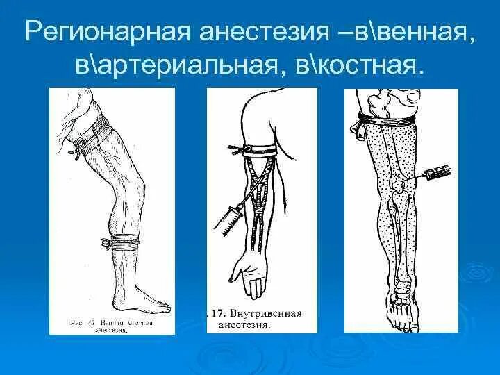 Внутрикостная блокада. Внутривенная регионарная анестезия. Внутривенная региональная анестезия это. Реагонарный анестезия. Проводниковая (регионарная) анестезия.