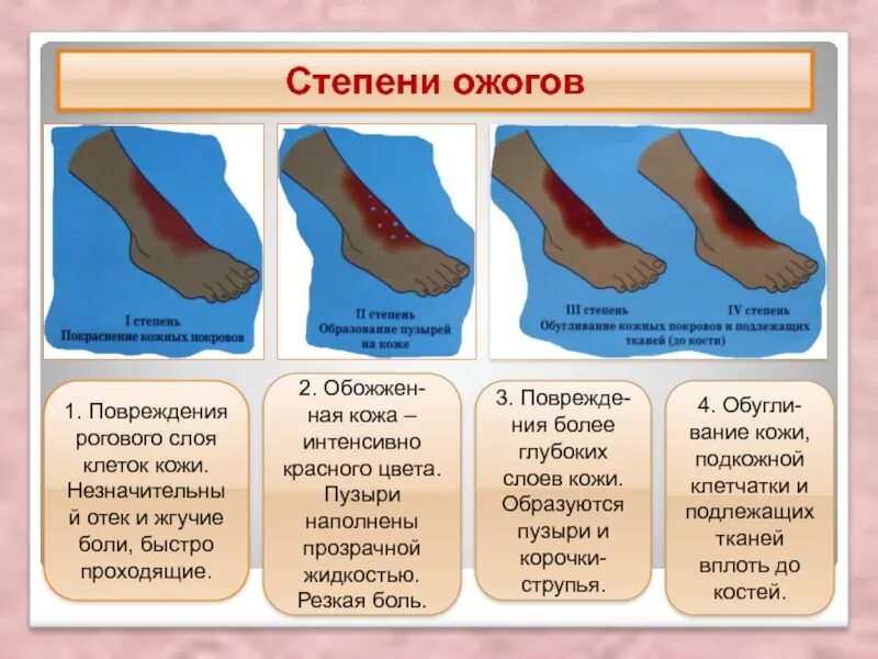 Ожоги обж 8 класс. Стадии ожога таблица. Ожоги клинические проявления степень таблица. Первая степень ожогов таблица вид.