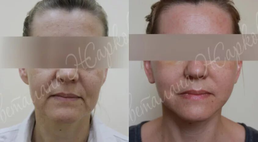 Круговая пластика лица. Брыли до и после фейслифтинга. Косметические процедуры для лица после 60 лет. Процедура для лица после 60