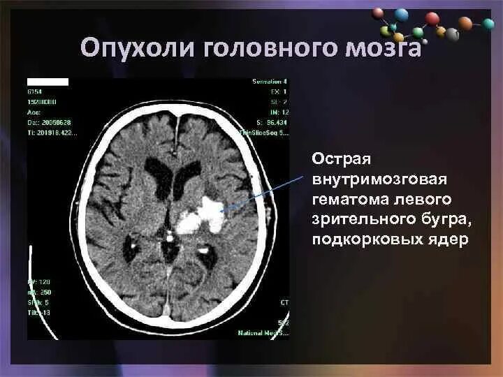 Диагноз кт с опухолью головного мозга. Глиобластома головного мозга на кт. Кт ГМ отек головного мозга. Диагностические критерии глиомы головного мозга. Диагноз опухоли головного